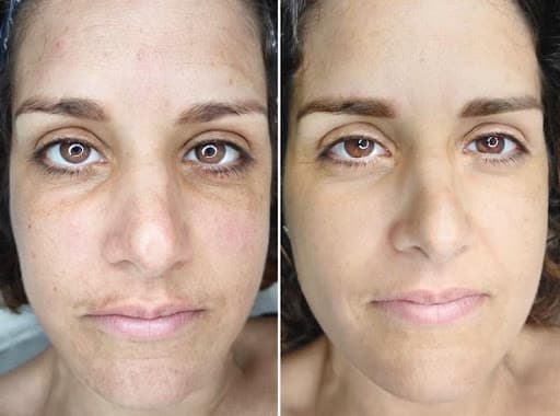 Essence of Beauty Bio Microneedling Treatment