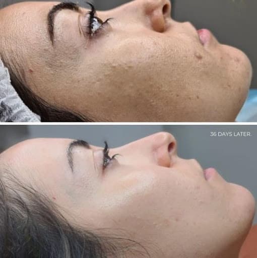 Essence of Beauty Bio Microneedling Treatment