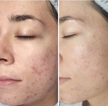 Before & After Acne Treatment