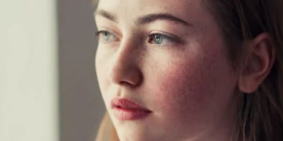 Hyperpigmentation & Melasma