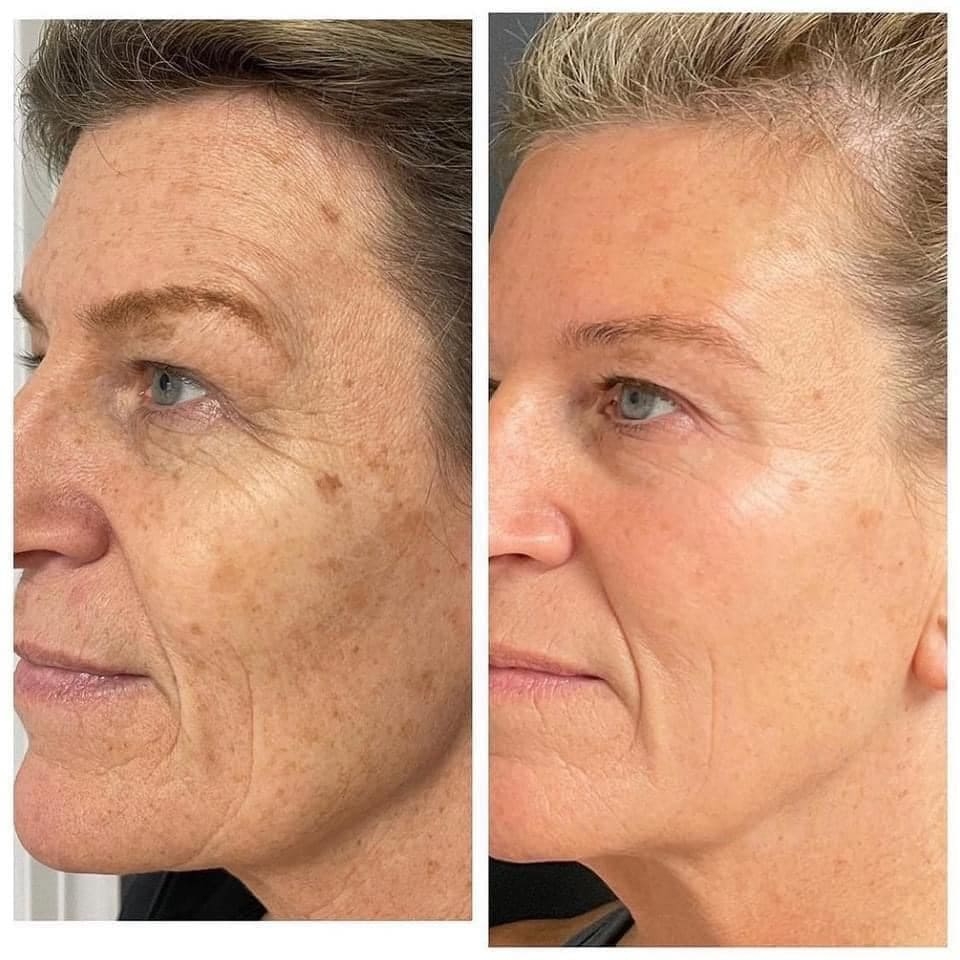 Microneedling Before & After Treatment at Essence of Beauty Ottawa