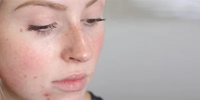 Holistic Acne Clinic