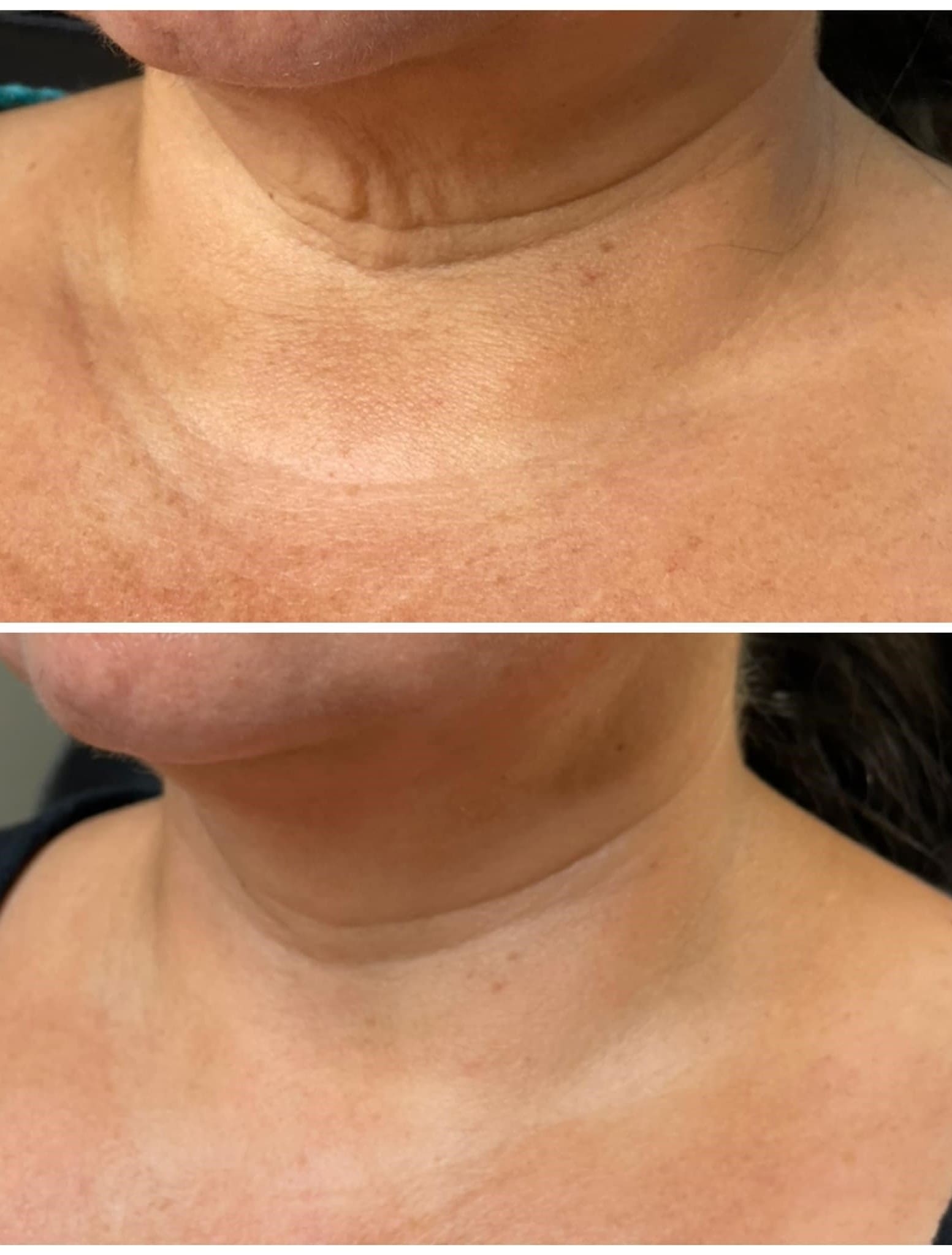 Microneedling Before & After Treatment at Essence of Beauty Ottawa