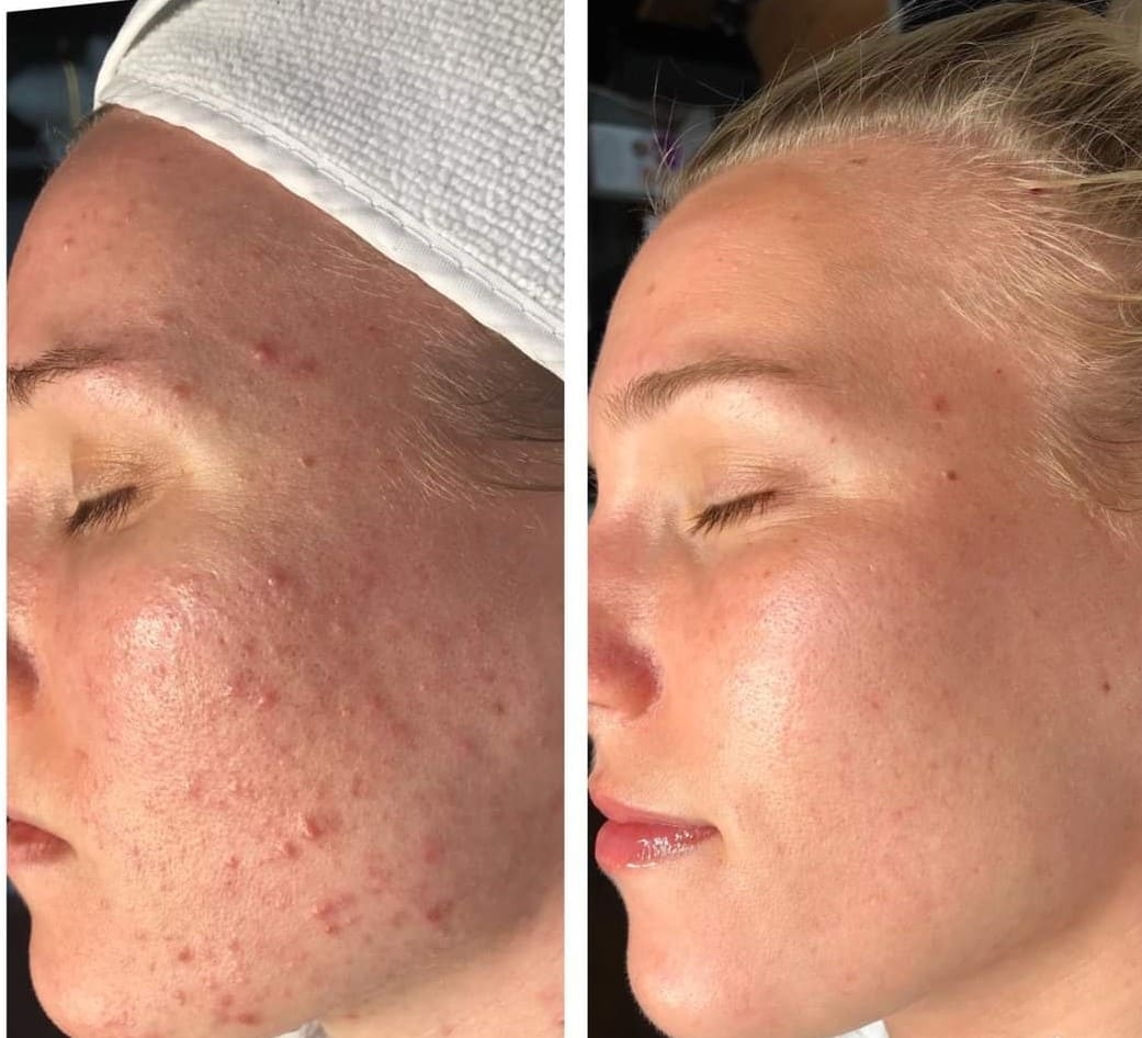 Before & After Acne Treatment