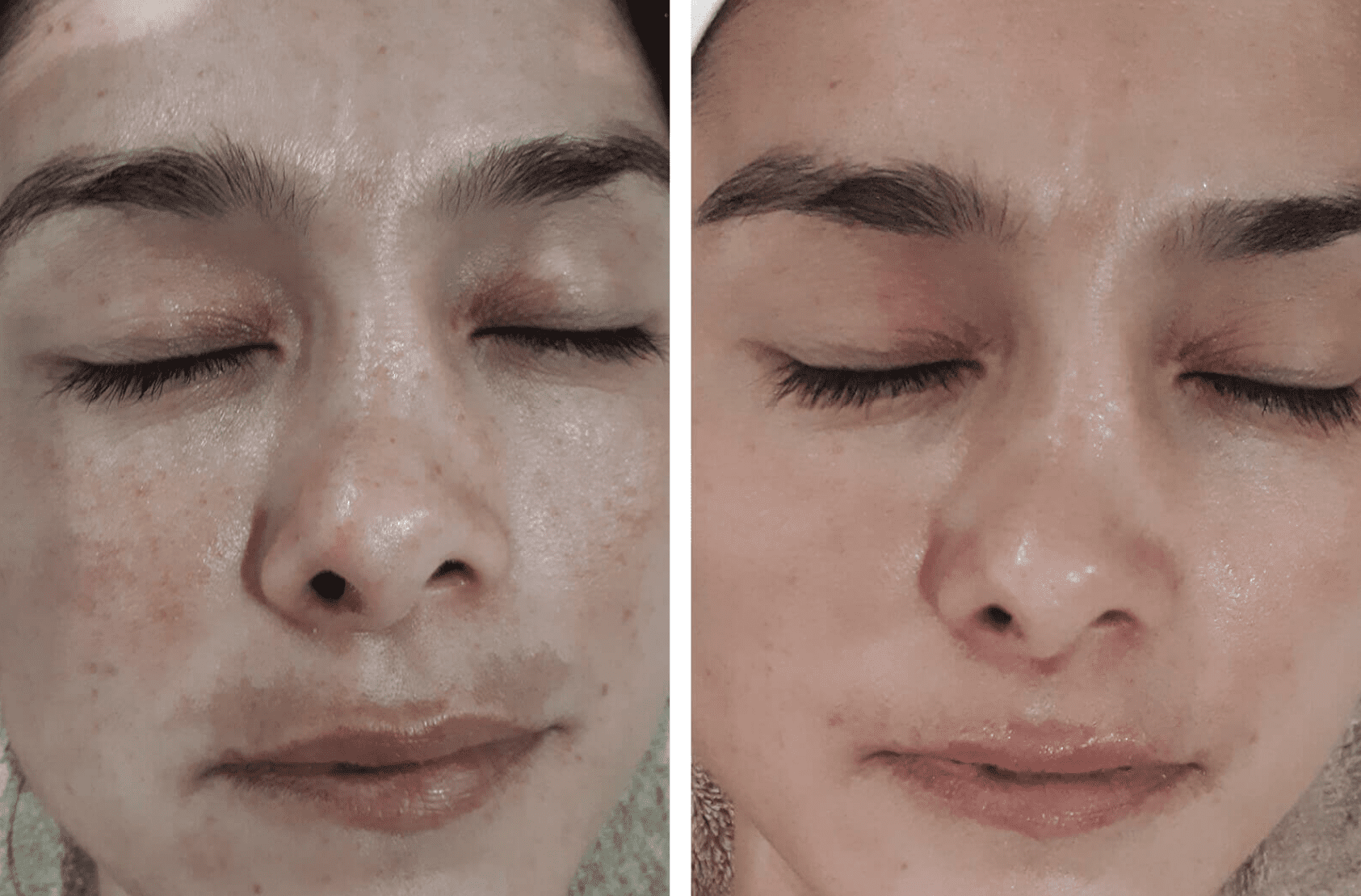 Hyperpigmentation & Melasma After Treatment Image