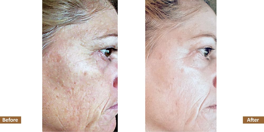 Hyperpigmentation & Melasma Before & Treatment Image