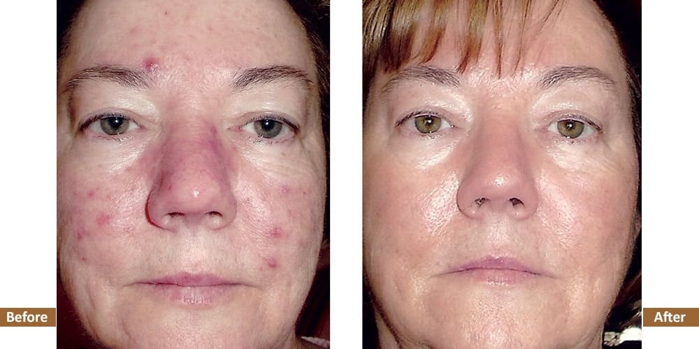 Holistic Acne Program Before & After Treatment Image