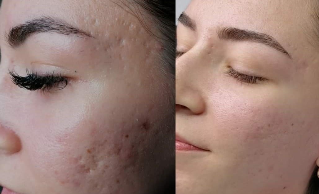 Microneedling Before & After Treatment at Essence of Beauty Ottawa