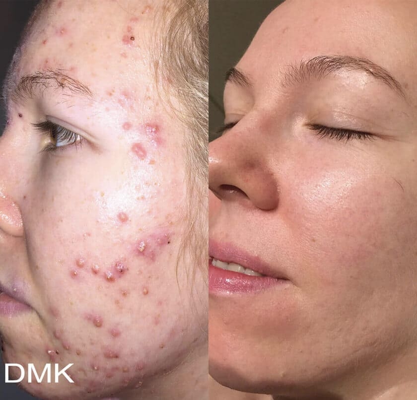 DMK Enzyme Therapy Before & After