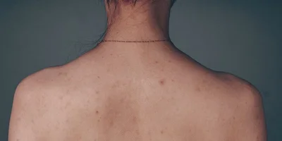 Back Acne Treatment