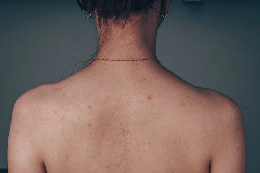 Essence of Beauty Ottawa - Back Acne Treatment