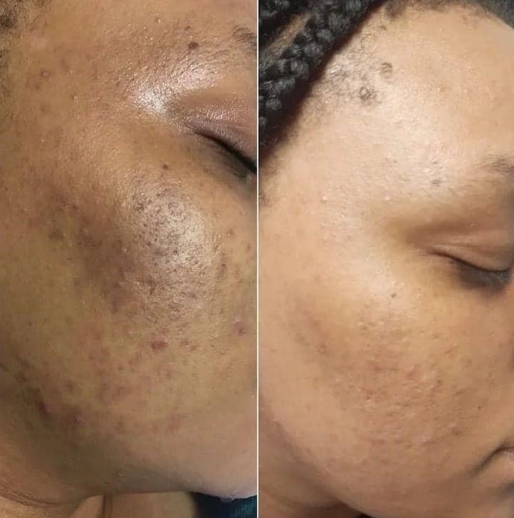 AfterGlow Peel Before & After Treatment