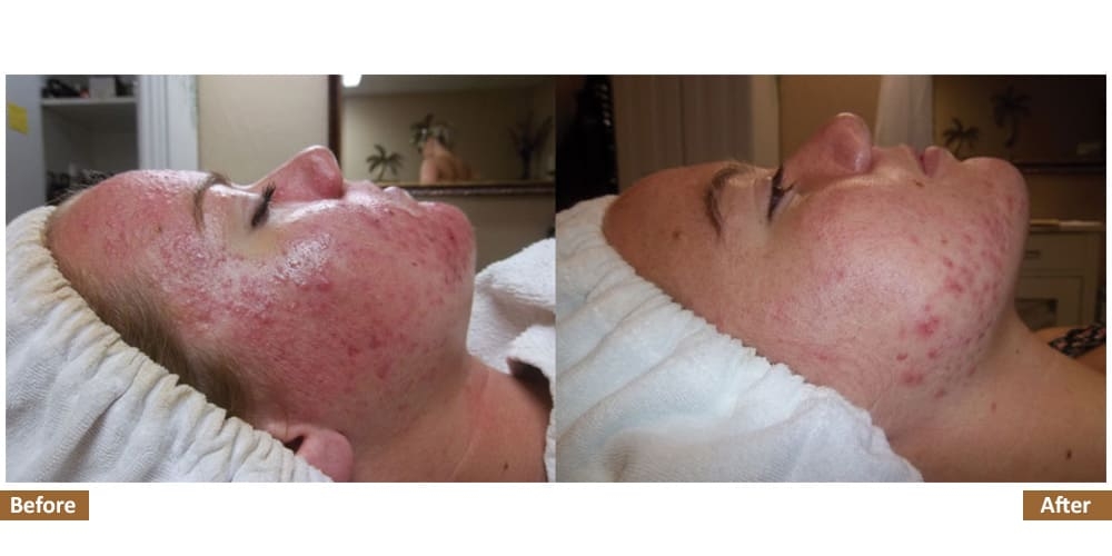 Holistic Acne Program Before & After Treatment Image