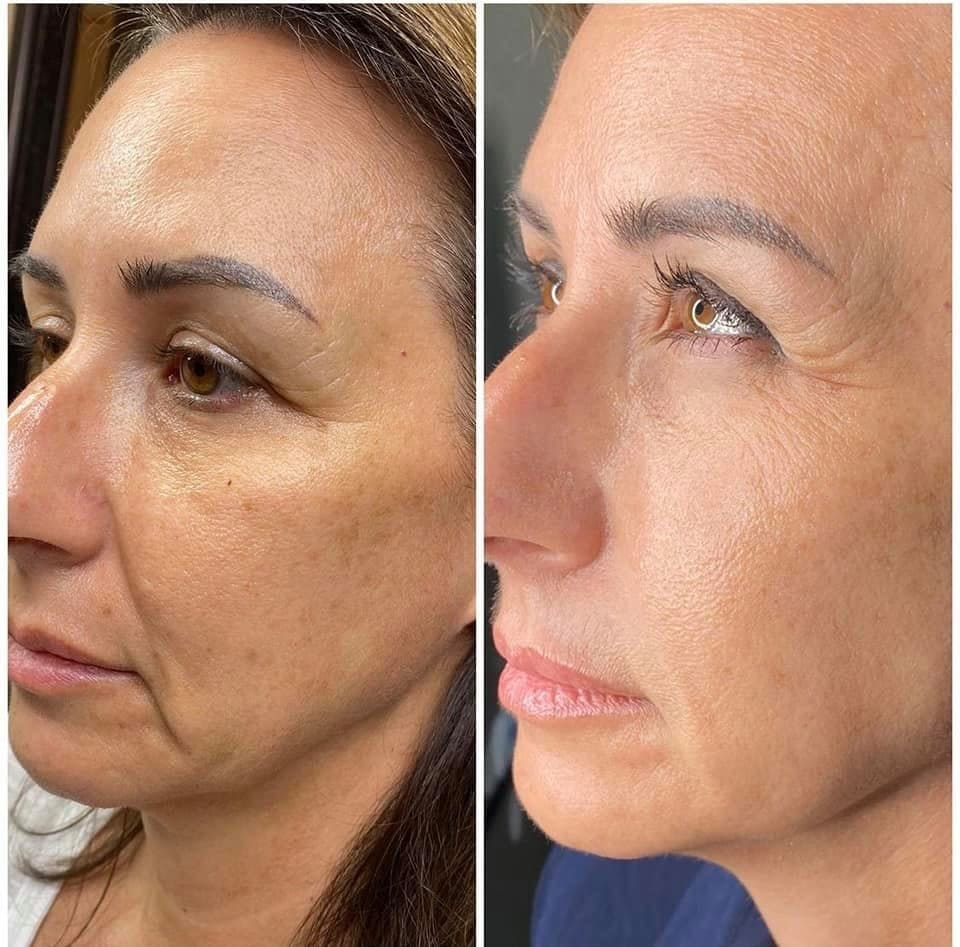 Microneedling Before & After Treatment at Essence of Beauty Ottawa