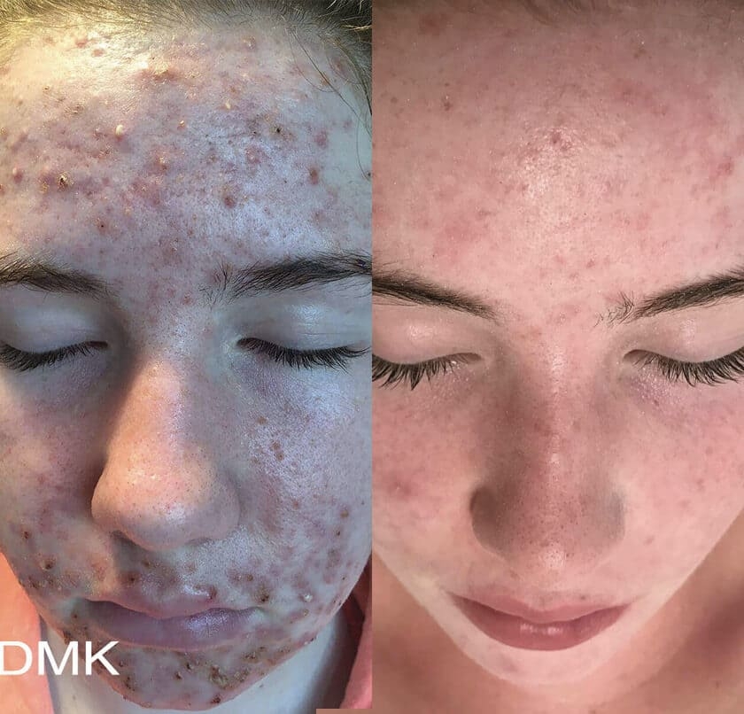 DMK Enzyme Therapy Before & After