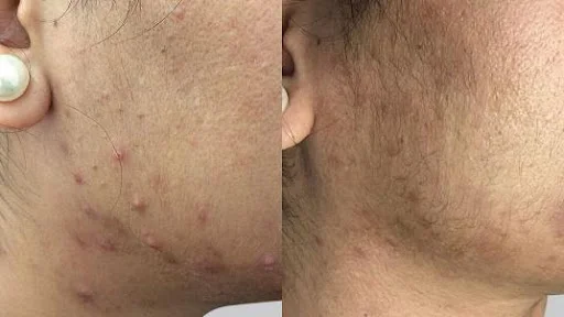 Restorative Bio Peel Before & After