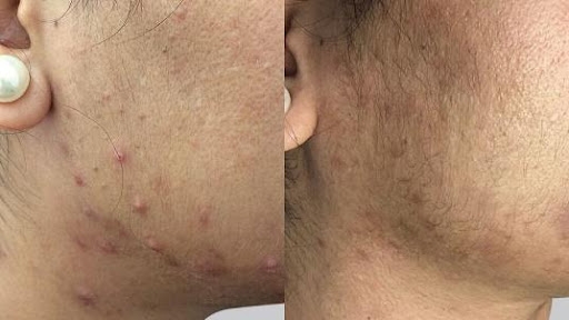 Restorative Bio Peel Before & After