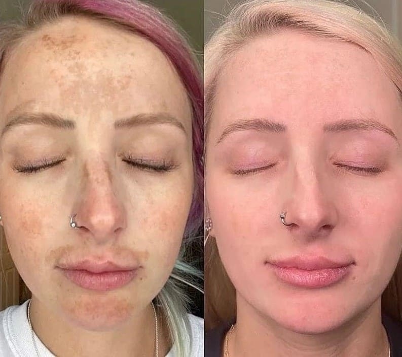 AfterGlow Peel Before & After Treatment