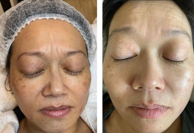 Before & After Treatment