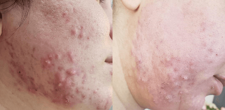 Restorative Bio Peel Before & After