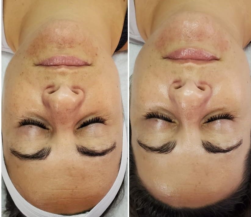 AfterGlow Peel Before & After Treatment