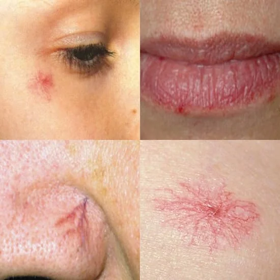 Telangiectasia Spider Angiomas