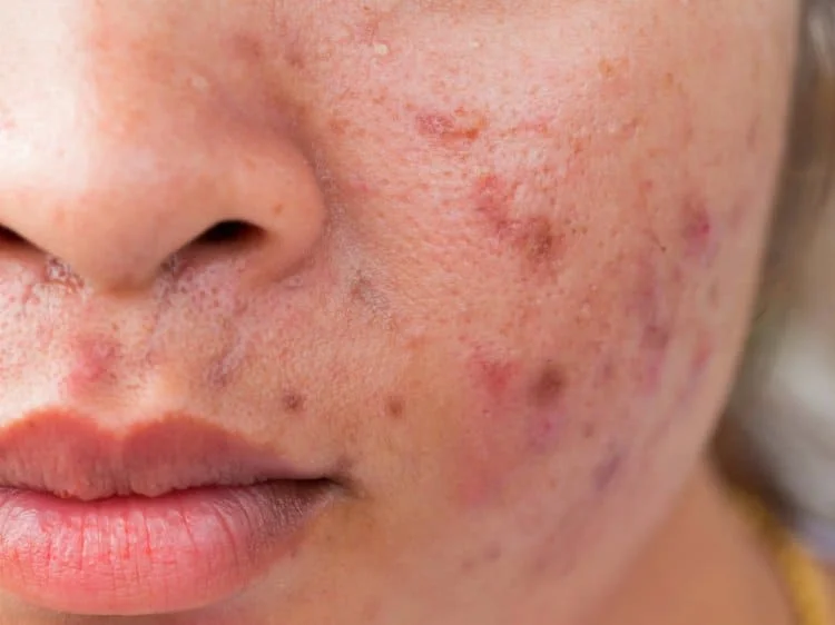 Does Milk Trigger Acne? featured image