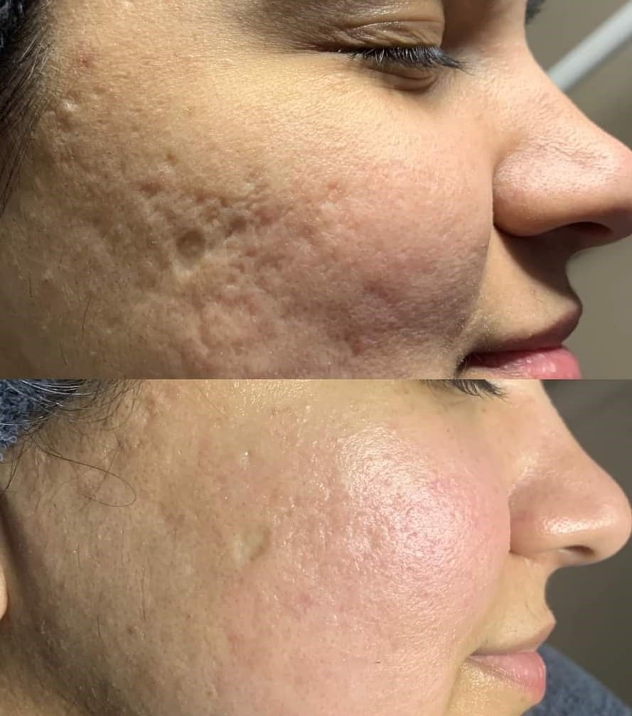 Microneedling Before & After Treatment at Essence of Beauty Ottawa