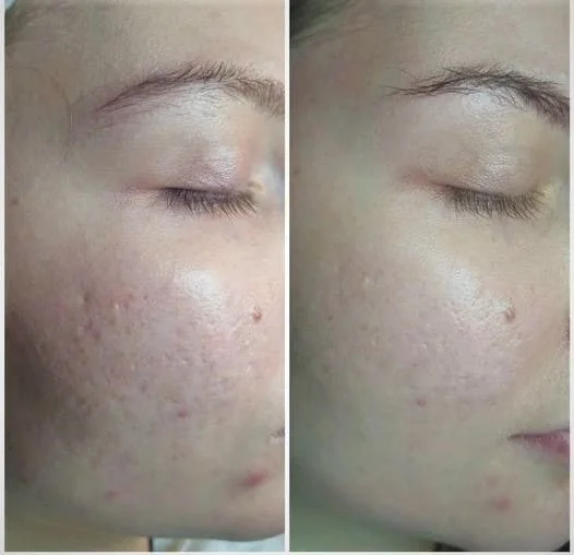 Before & After Acne Treatment