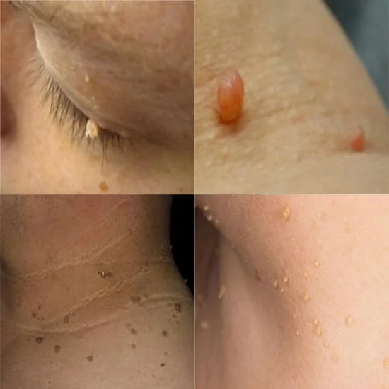 Skin Tags