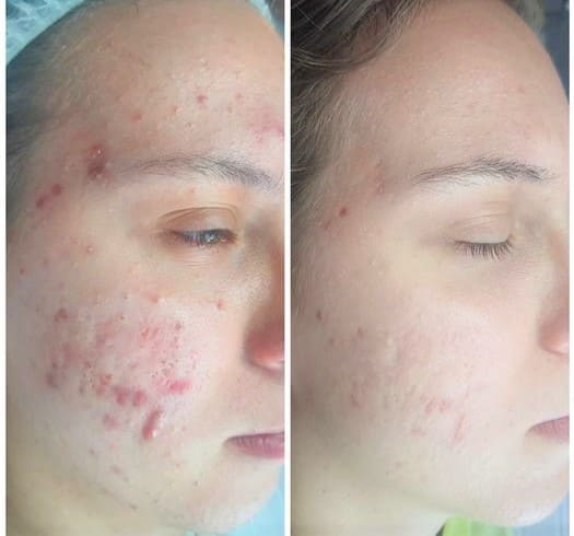 Before & After Cystic Acne Treatment