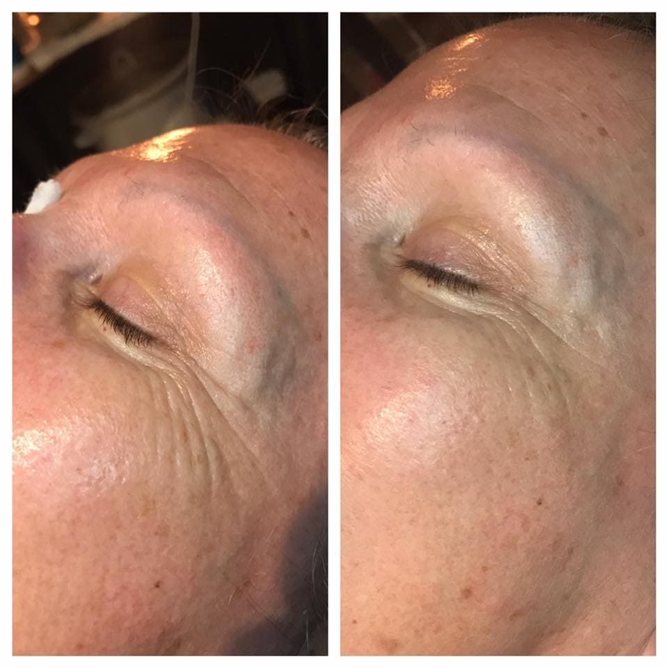 Before & After Treatment