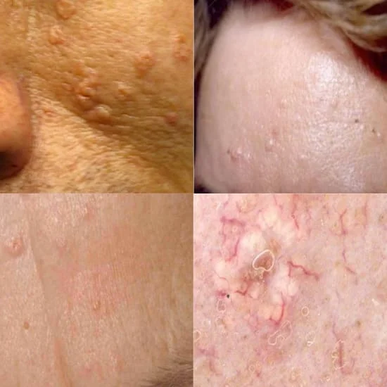 Sebaceous Hyperplasia