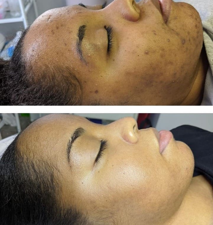 AfterGlow Peel Before & After Treatment