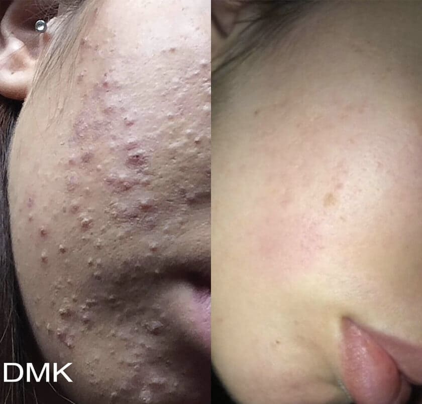 DMK Enzyme Therapy Before & After