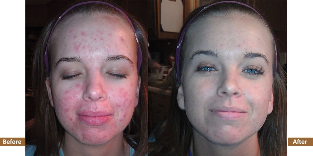 Virtual Acne Program Before & After Treatment Image