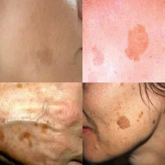 Flat Hyperpigmentation Sun Age Spots