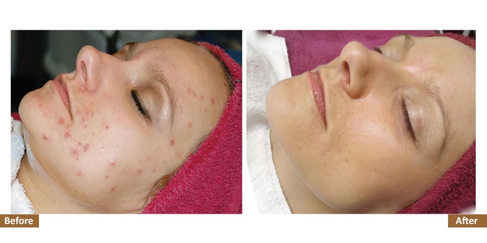 Holistic Acne Program Before & After Treatment Image