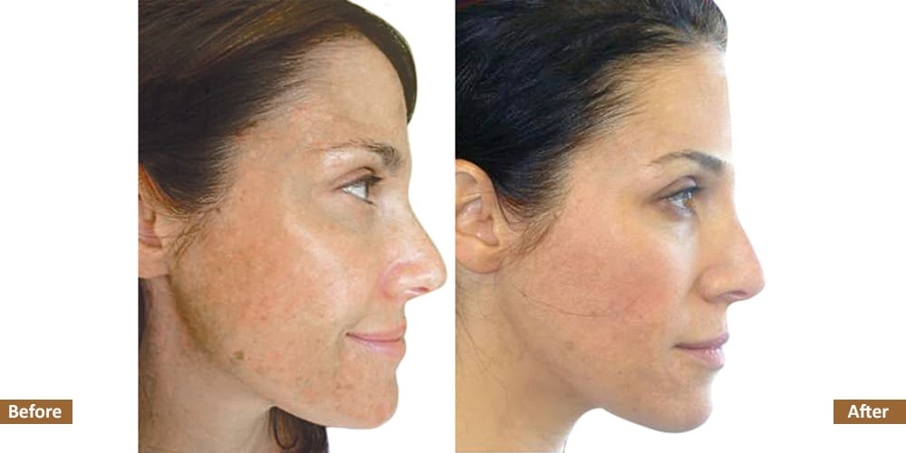 Hyperpigmentation & Melasma Before & Treatment Image