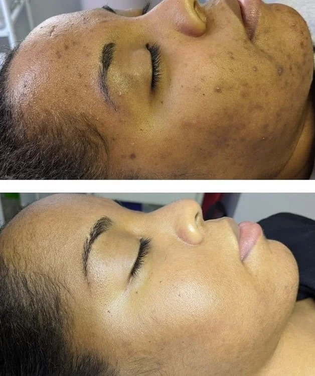 Hyperpigmentation & Melasma