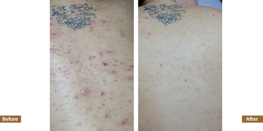 Holistic Acne Program Before & After Treatment Image