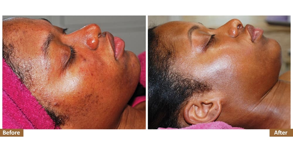 Hyperpigmentation & Melasma Before & Treatment Image