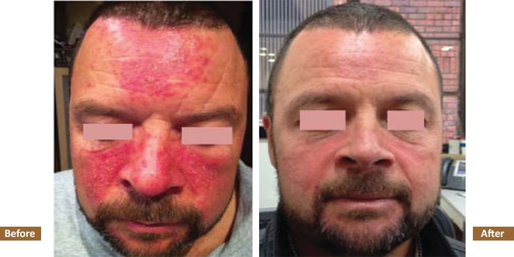 Rosacea Before & After Treatment Image