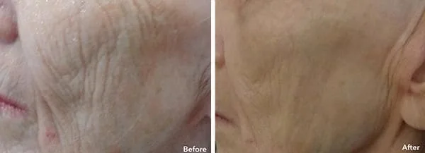 AnteAge Before & After Treatment