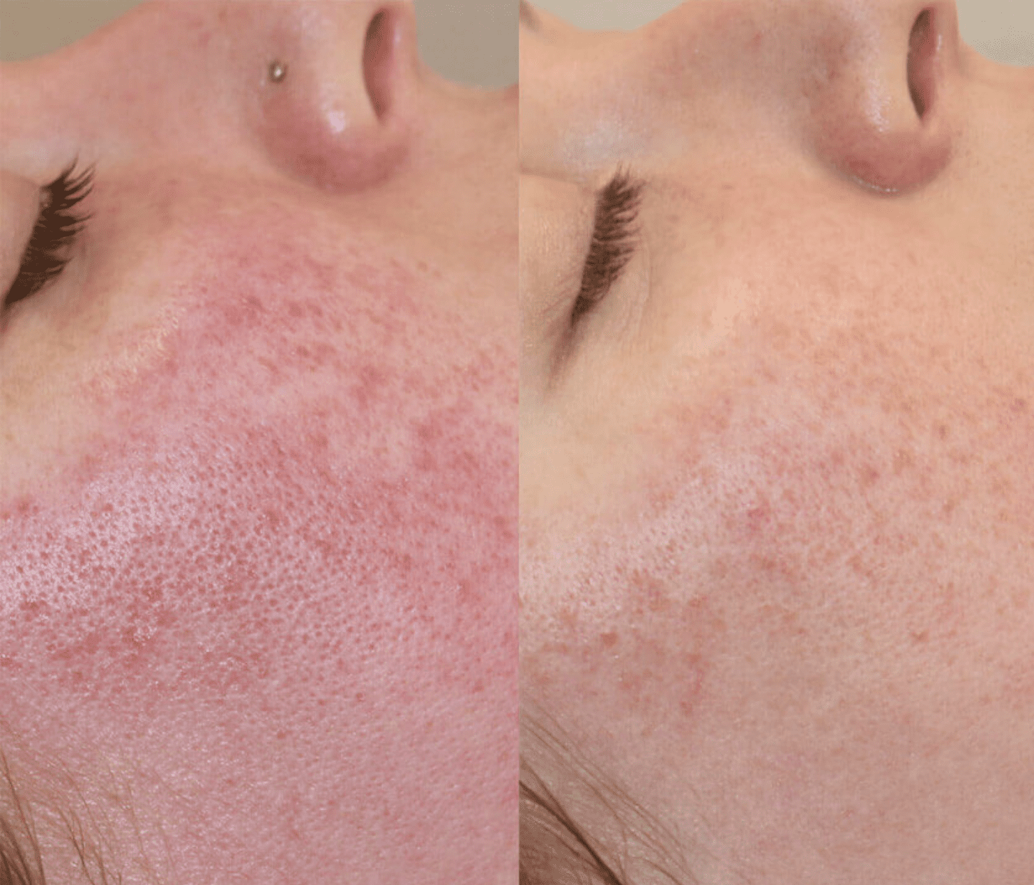 Rosacea Before & After Treatment Image