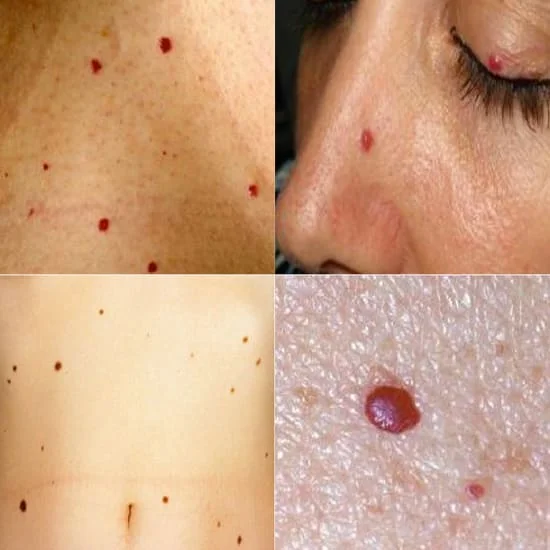 Cherry Angiomas Ruby Spots