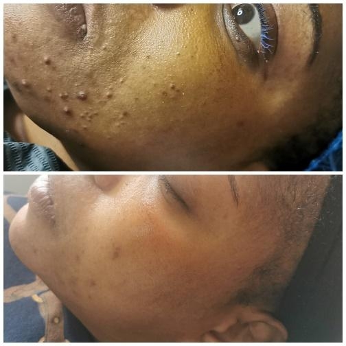 Restorative Bio Peel Before & After