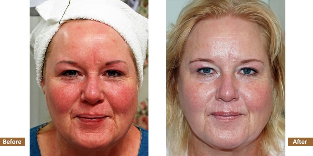 Rosacea Before & After Treatment Image