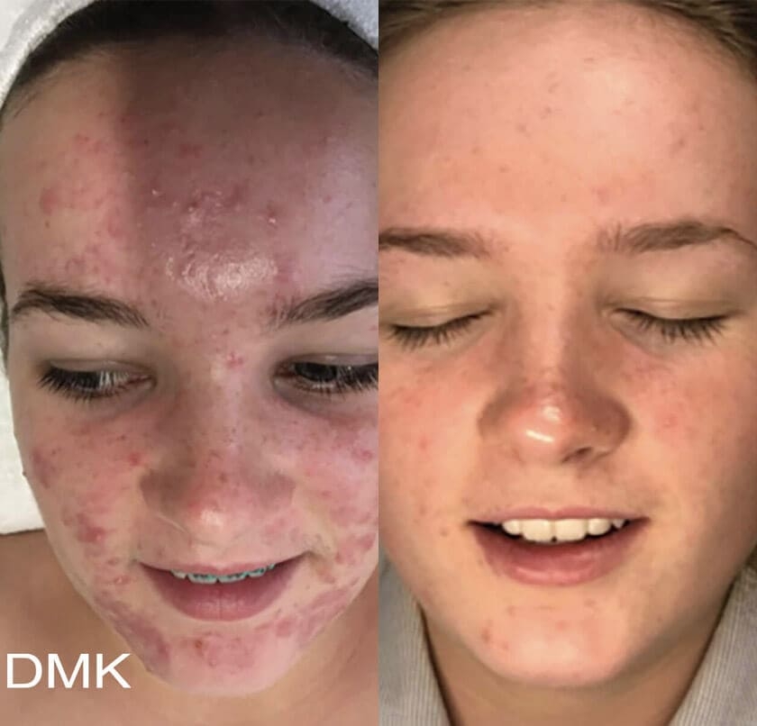 DMK Enzyme Therapy Before & After