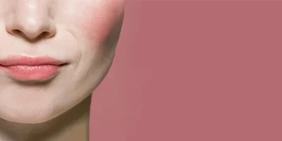 Rosacea & Sensitive Skin